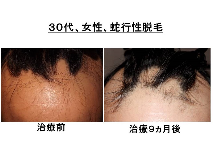 円形脱毛症　病院